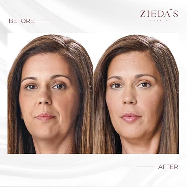 Dermal Filler — Real Results