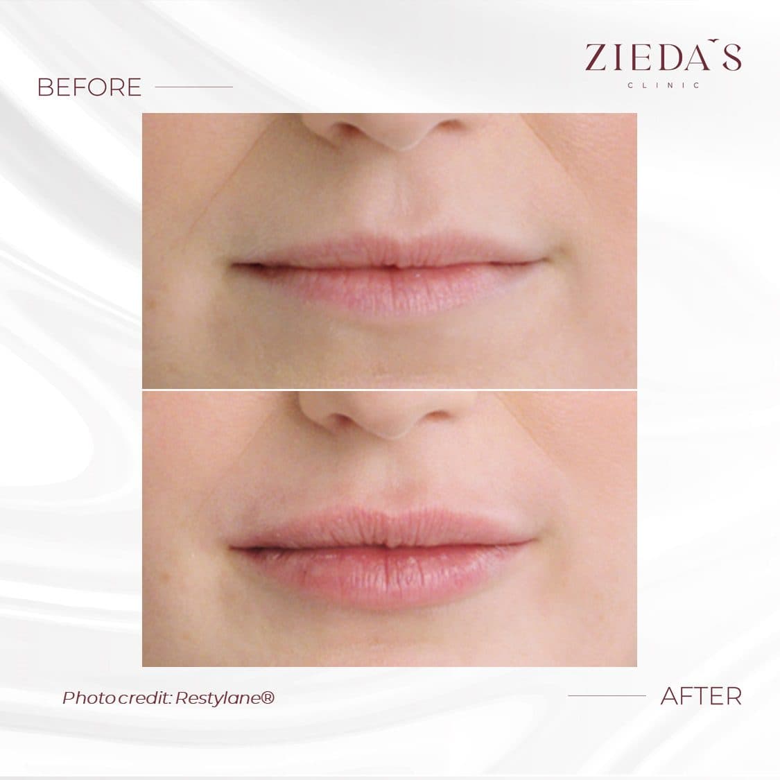 Lip Filler — Real Results