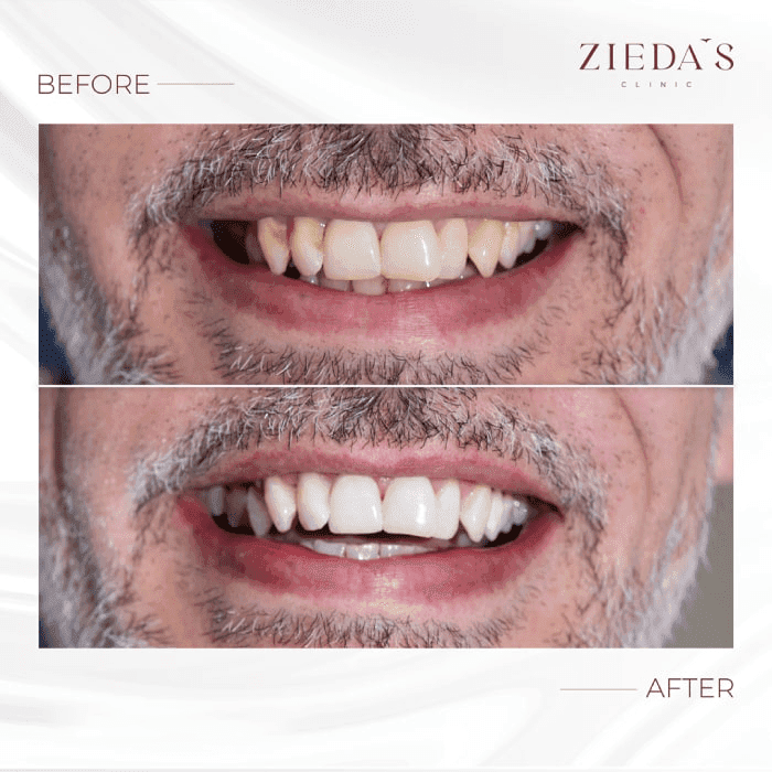 Smile Design — Real Results
