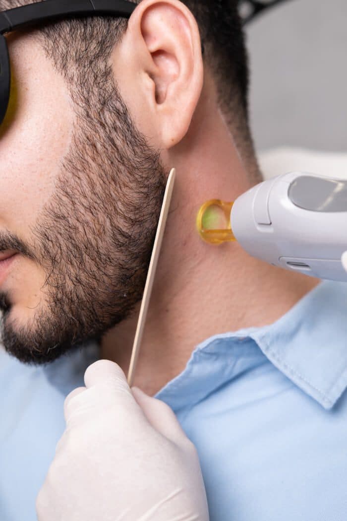 Laser Hair Removal for Men